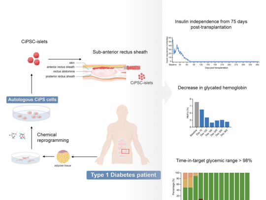 Transplantace kmenových buněk - ostrůvků u pacienta s diabetem 1. typu